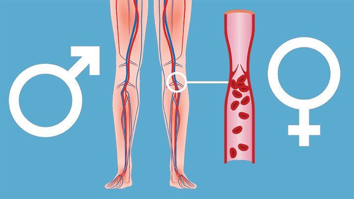 the truth about sex differences in deep vein thrombosis 722x406 1