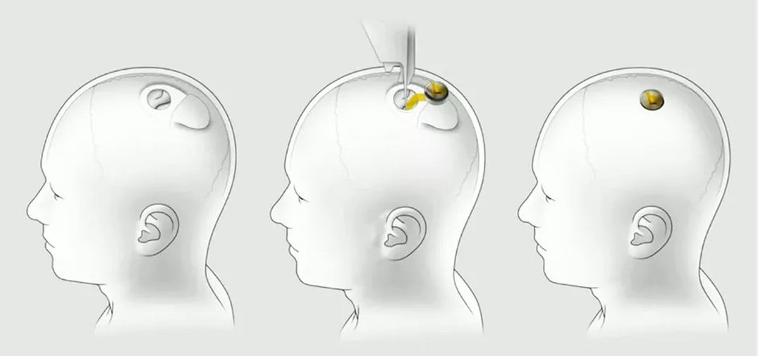 implant brain tesla